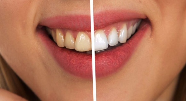 Причины появления желтого налета на зубах и способы его устранения